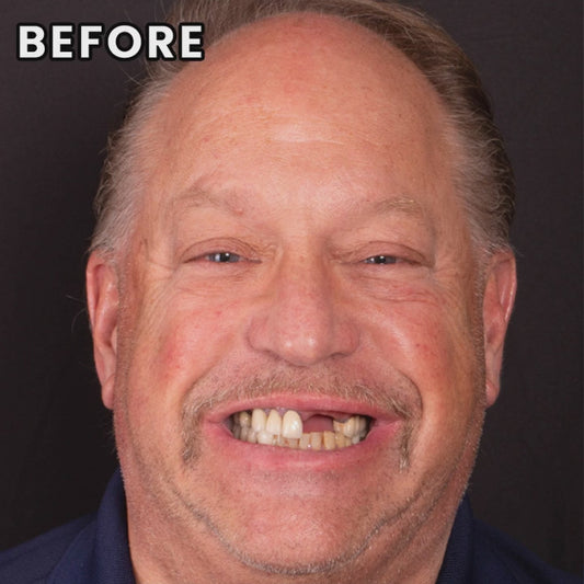 InstaSmile - Moldable Instant Veneers